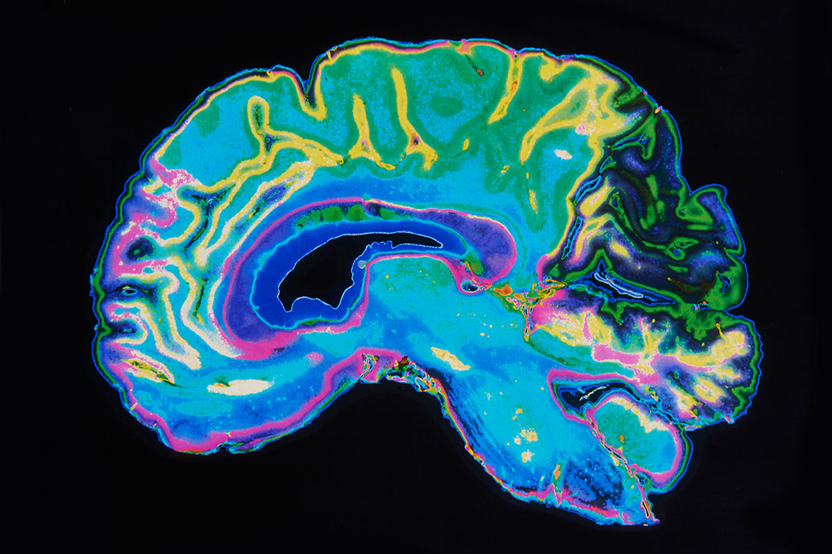 An MRI scan of a brain, illuminated in blue, green, yellow, and purple.