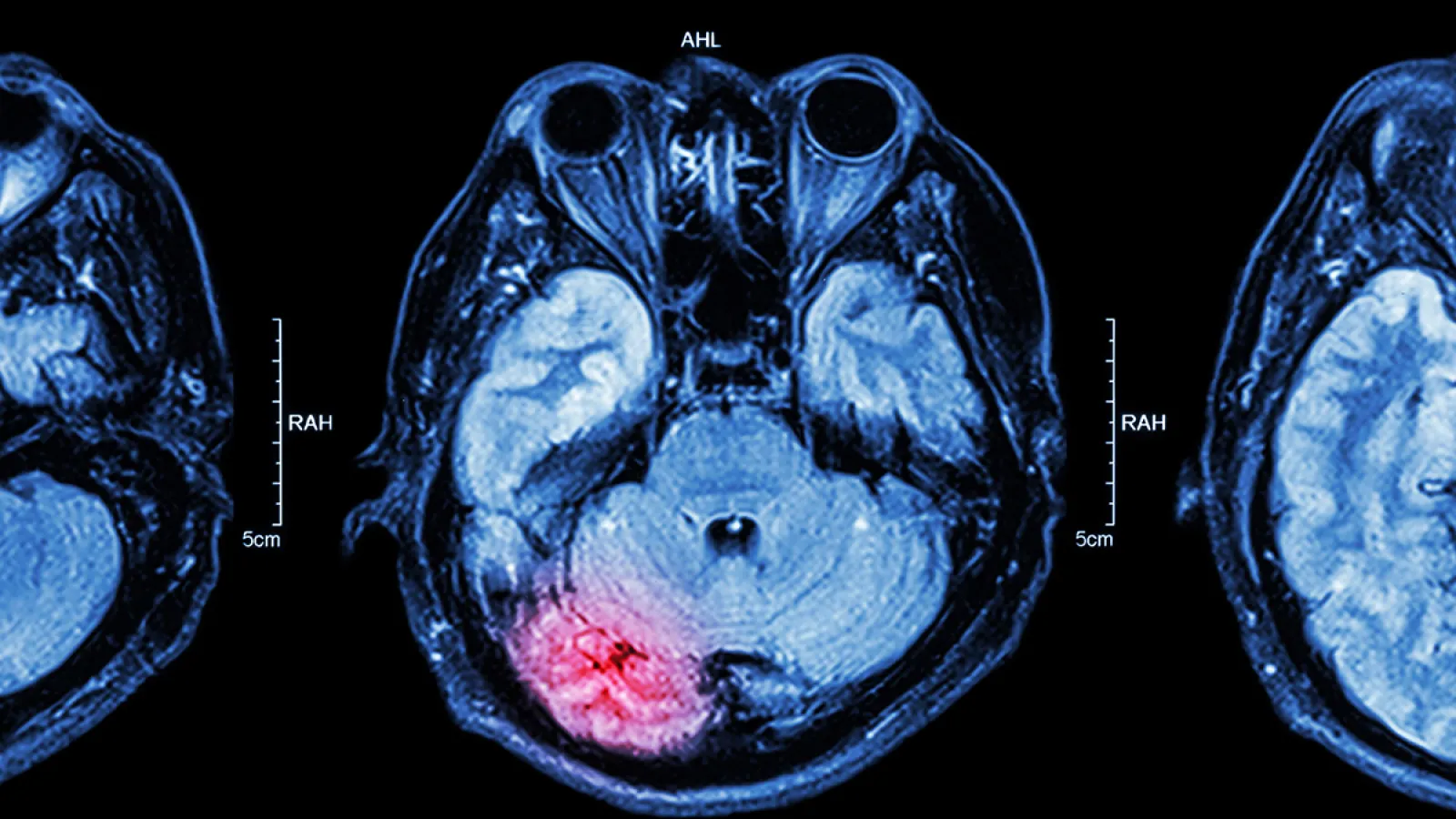 MRI of a brain with a glowing red region indicating injury