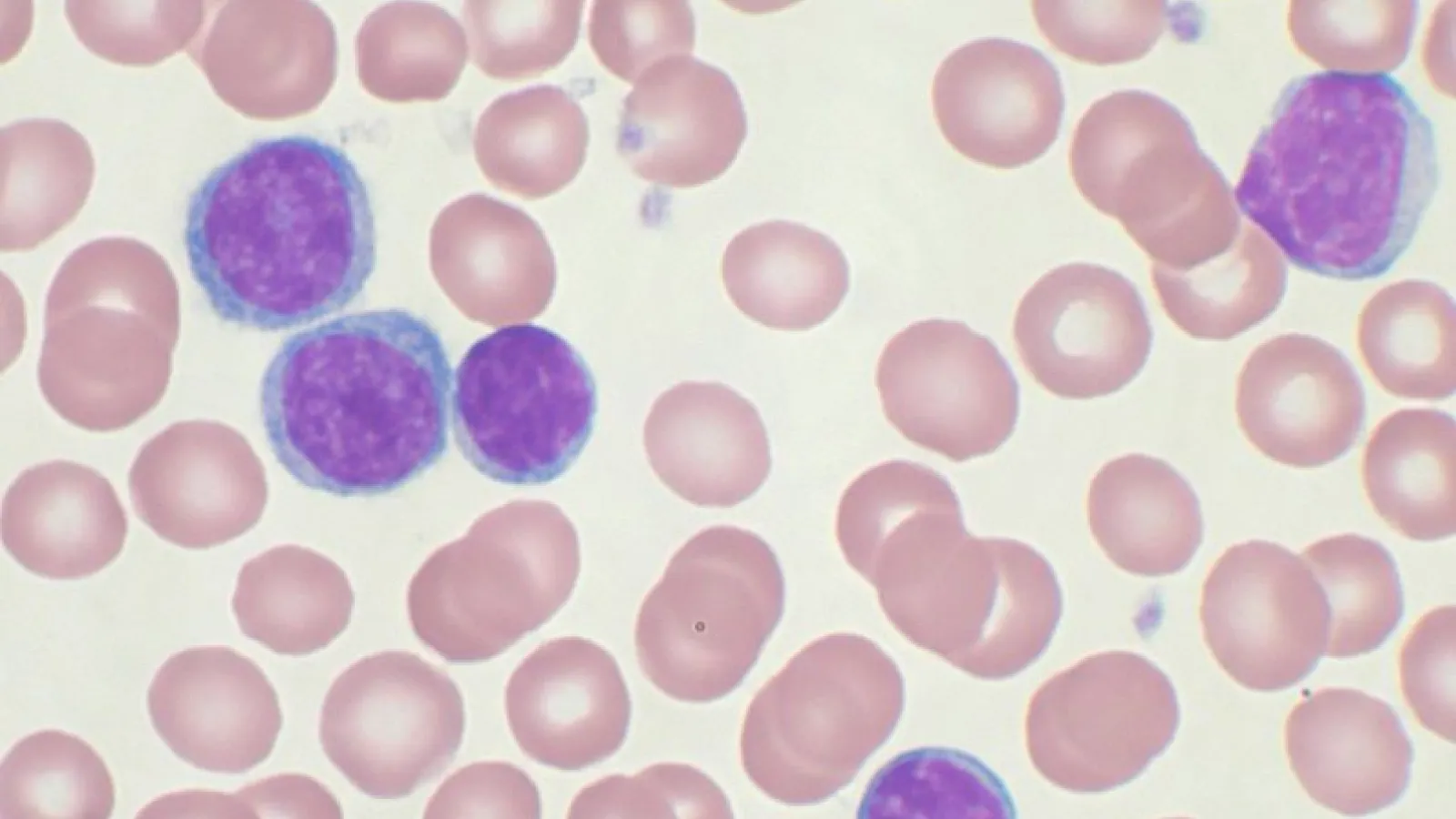 Chronic Lymphocytic Leukemia Cells in Blood