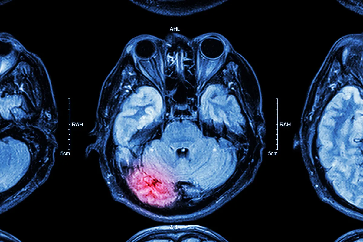 MRI of a brain with a glowing red region indicating injury