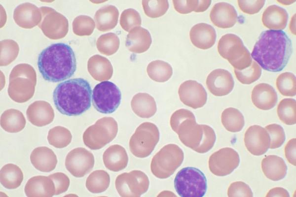 Chronic Lymphocytic Leukemia Cells in Blood